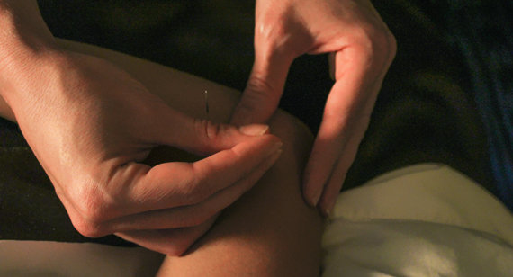 Art of Wellbeing: Acupuncture